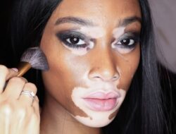 Penyebab Vitiligo: Hubungan Antara Stres Berat dan Penyebaran
